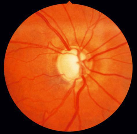 Un fond d’oeil révélant une papille de type glaucomateuse.