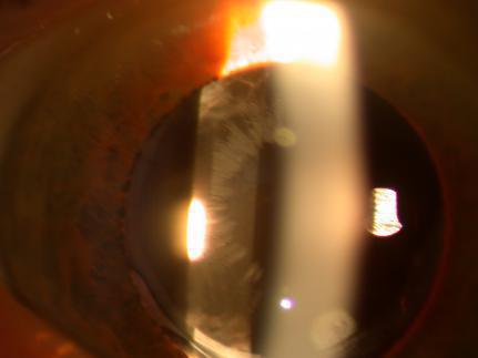 Récidive de pseudoexfoliation capsulaire sur implant