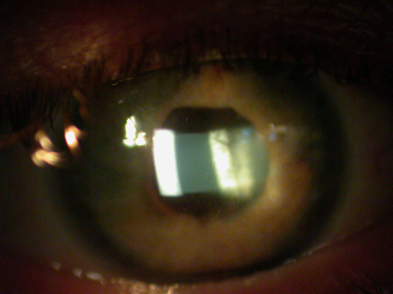 Tyndall (oeil inflammatoire)