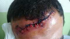 L'impressionnante blessure du jeune homme blessé aux Ulis.