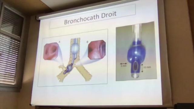 Ventilation unipulmonaire - Dr Ynineb