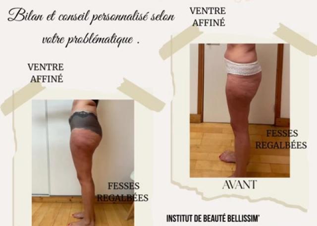 Endermologie LPG Corps