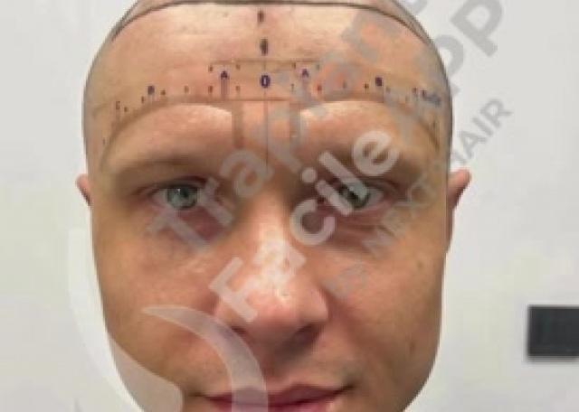 02 - Prima & Dopo Paziente con tecnica DHI
