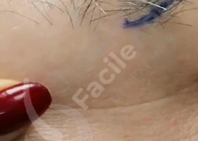 10 - Prima & Dopo Paziente con tecnica FUE