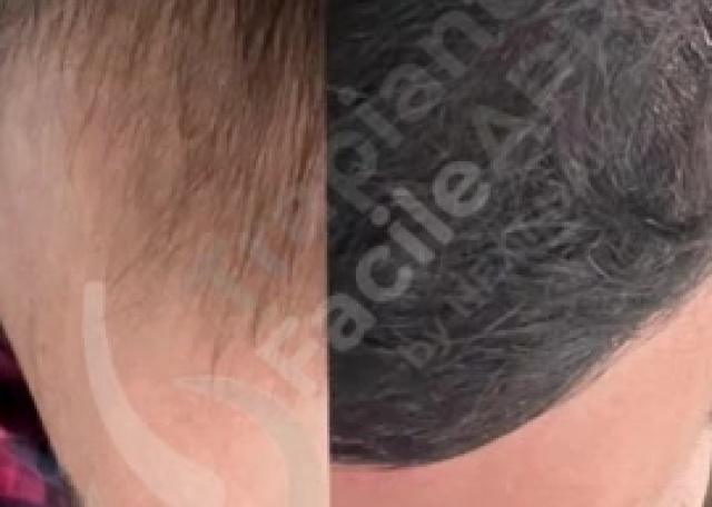 15 - Prima & Dopo Paziente con tecnica DHI