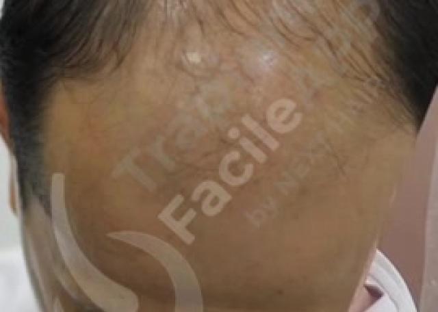 14 - Prima & Dopo Paziente con tecnica FUE