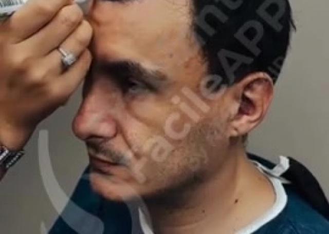 01 - Disegno nuovo Hairline  paziente