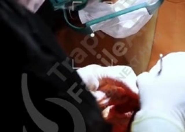 03 - Estrazioni Unità Follicolari con punch motorizzato