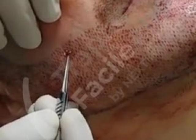Trapianto barba - innesto unità follicolari con tecnica FUE