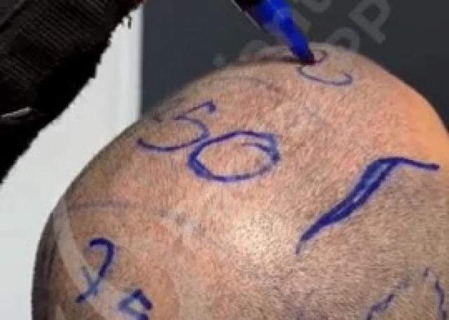 01 - Disegno nuovo Hairline paziente