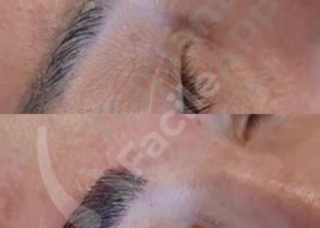 17 - Prima & Dopo Paziente trapianto sopracciglia tecnica L-Slit