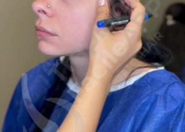 Intero processo operatorio trapianto di sopracciglia